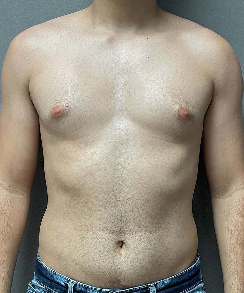 Gynecomastectomy Before & After