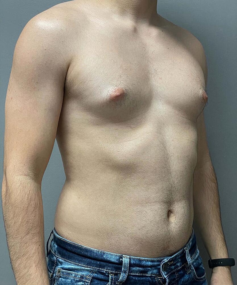 Gynecomastectomy Before & After