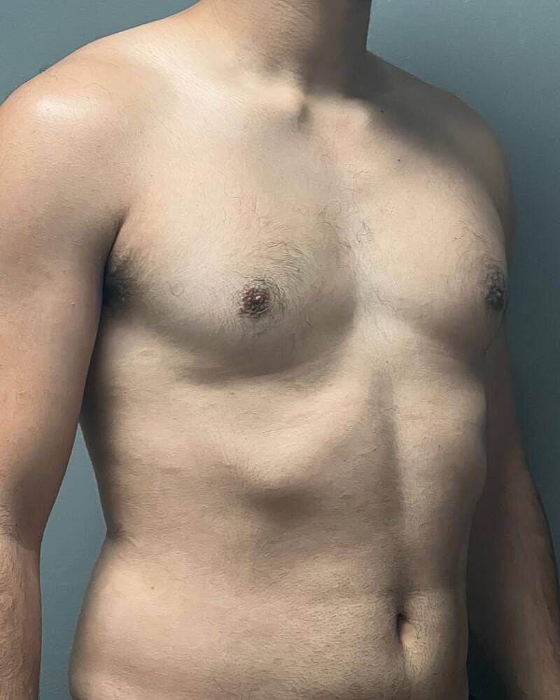 Gynecomastectomy Before & After