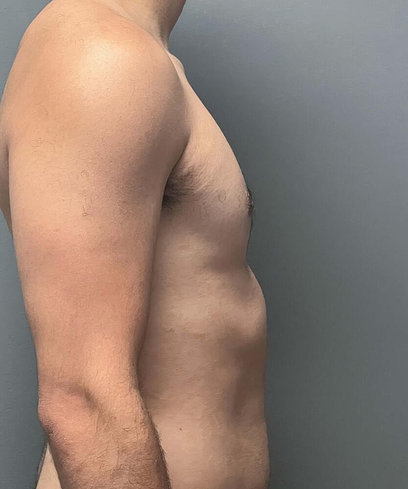 Gynecomastectomy Before & After
