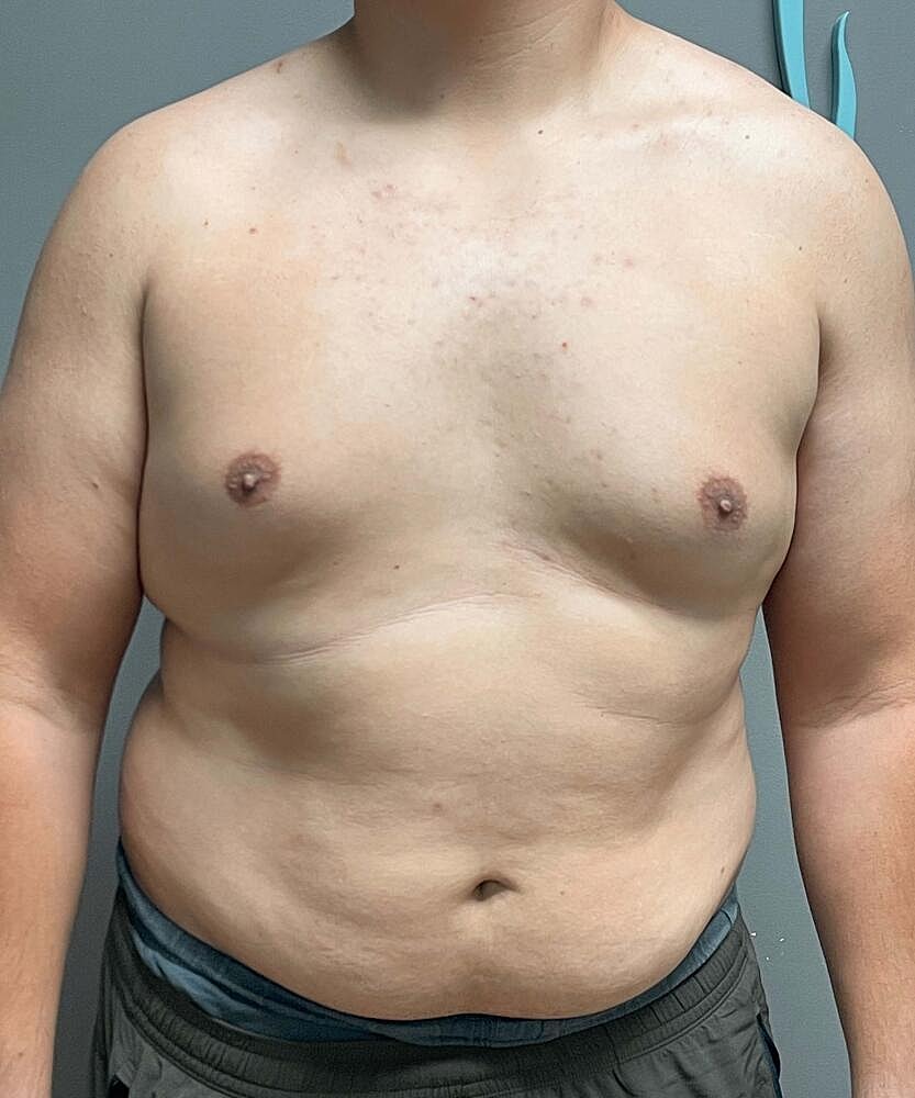 Gynecomastectomy Before & After