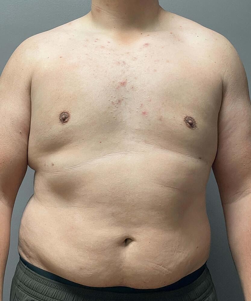 Gynecomastectomy Before & After