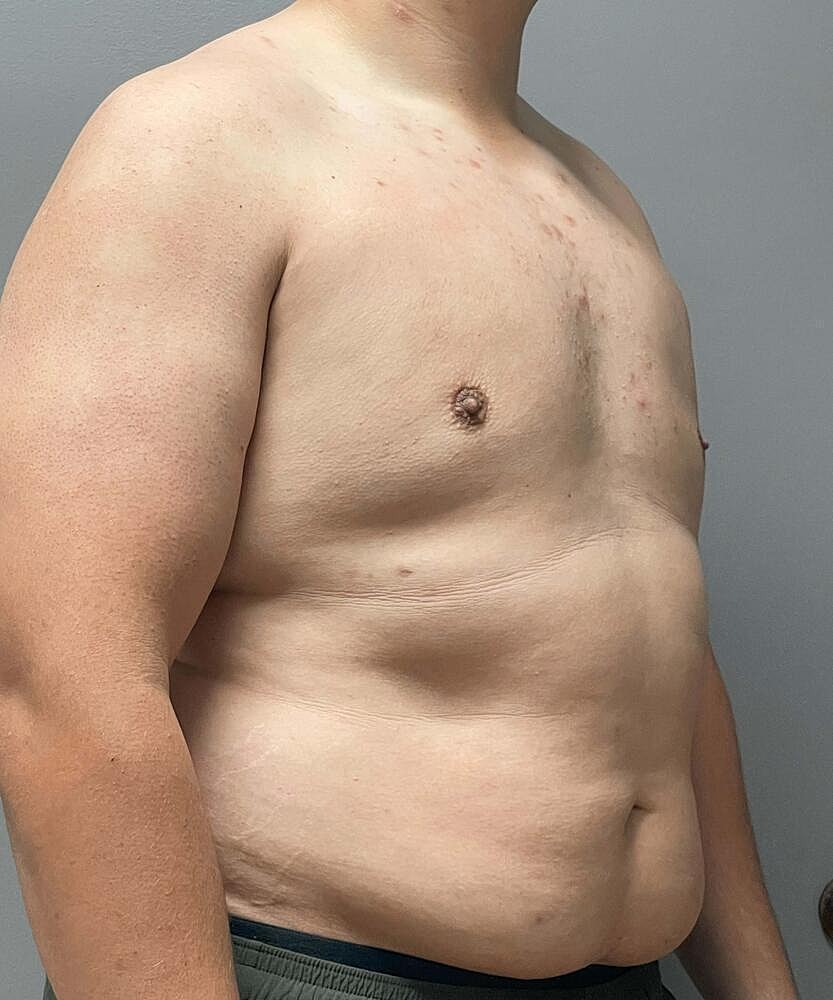 Gynecomastectomy Before & After
