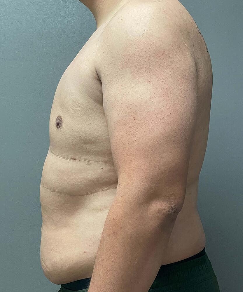 Gynecomastectomy Before & After