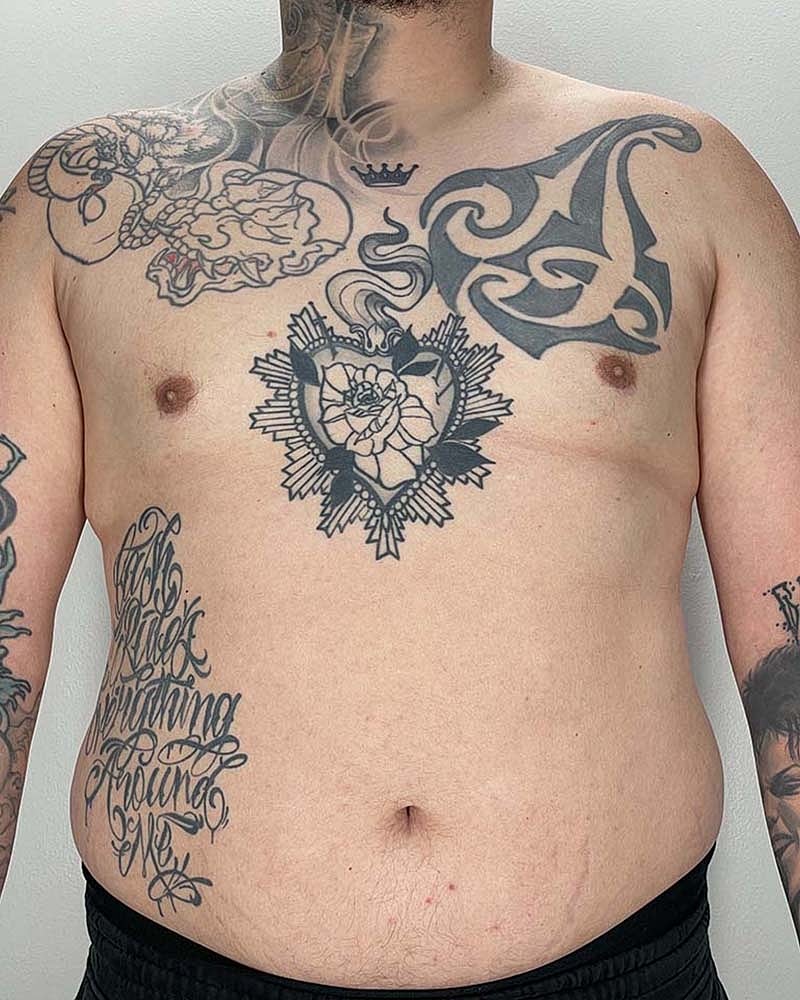 Gynecomastectomy Before & After