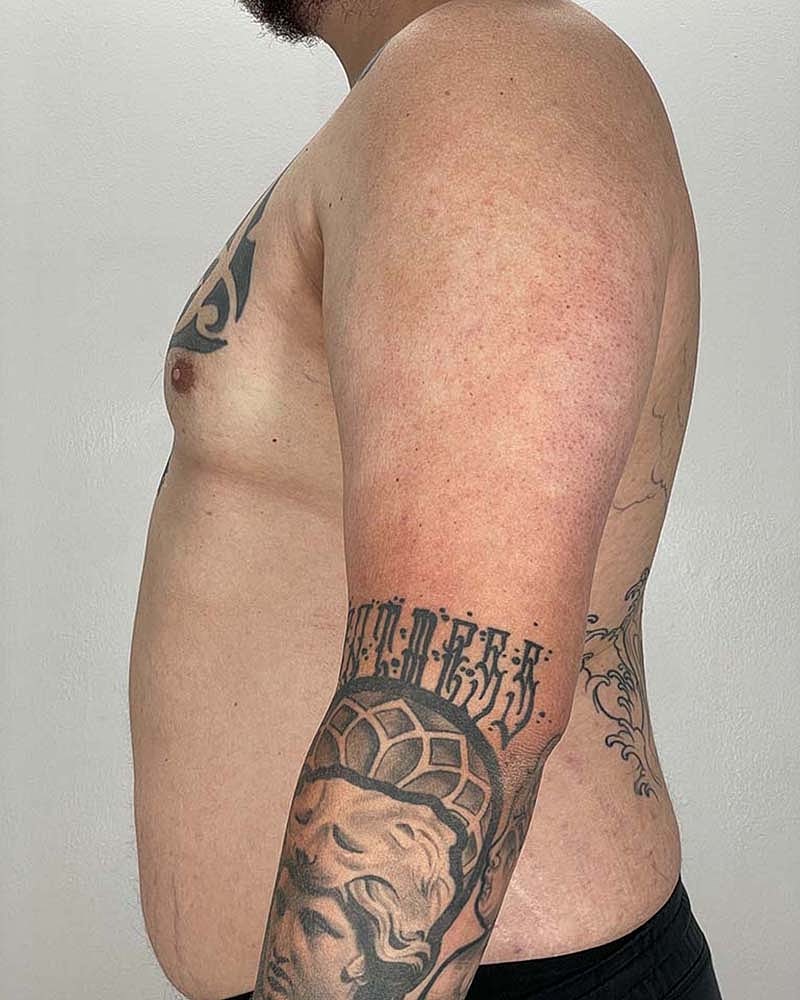 Gynecomastectomy Before & After