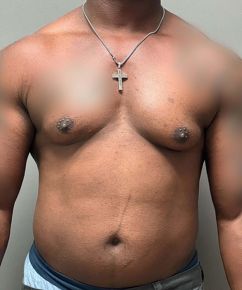 Gynecomastectomy Before & After