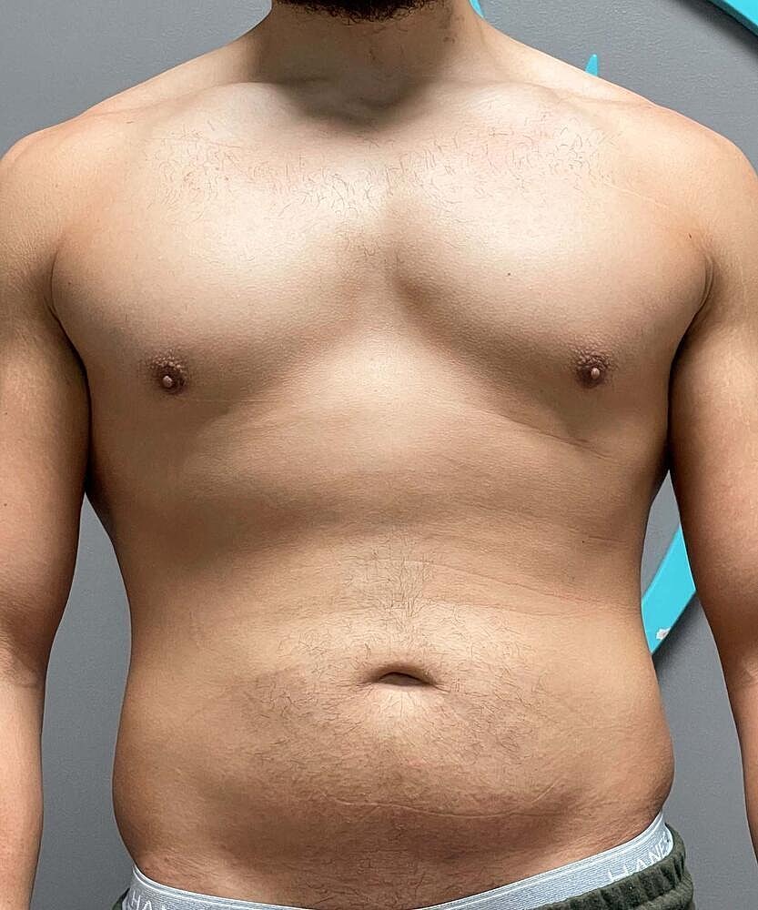 Gynecomastectomy Before & After