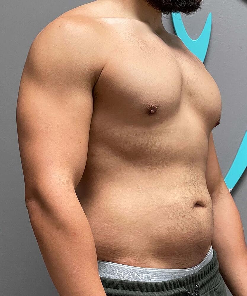 Gynecomastectomy Before & After