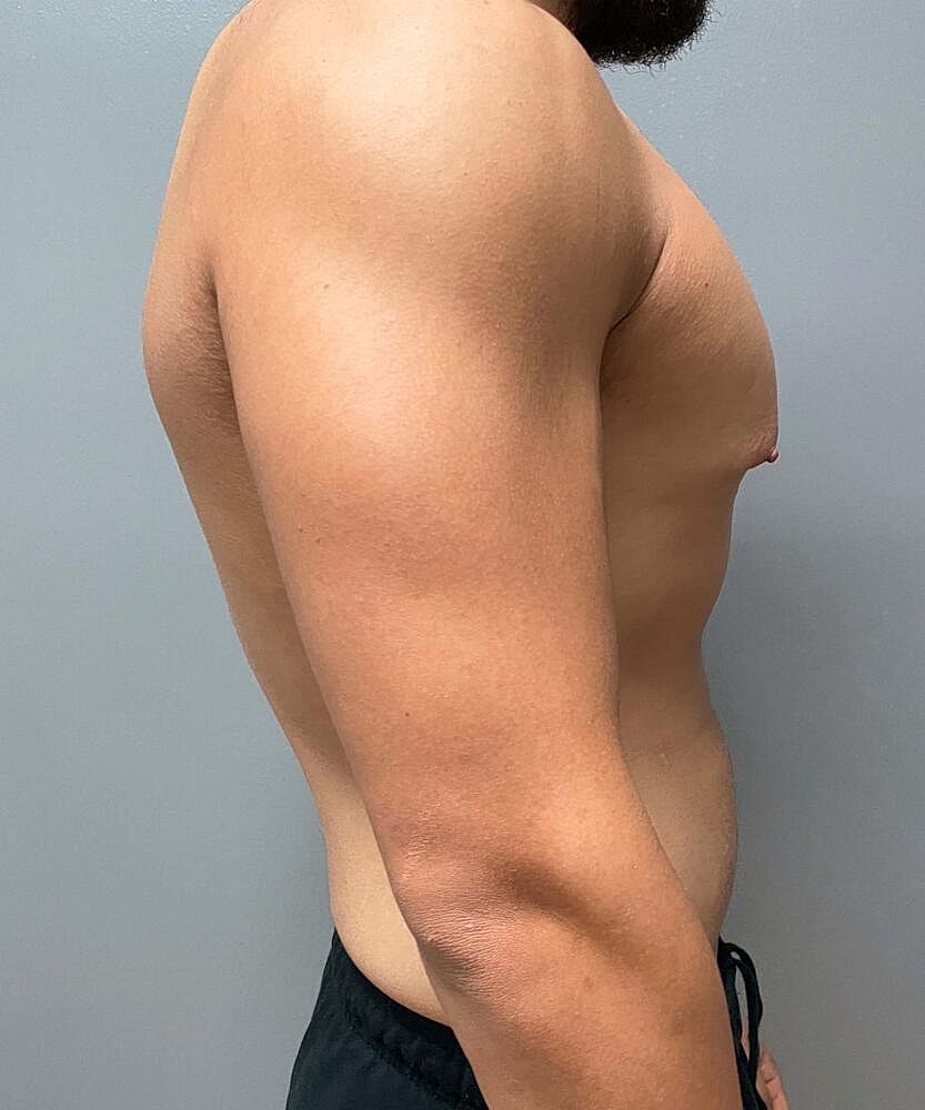 Gynecomastectomy Before & After