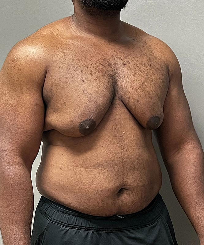 Gynecomastectomy Before & After
