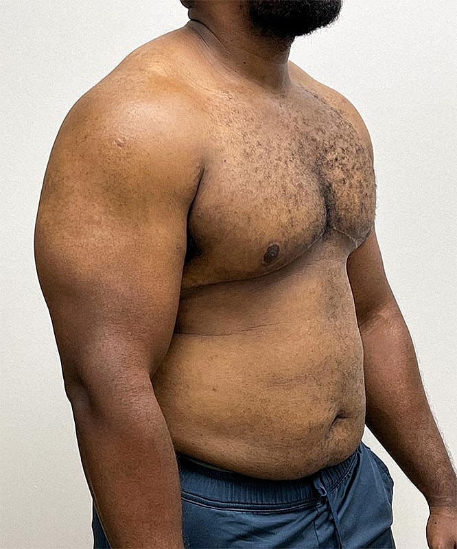 Gynecomastectomy Before & After
