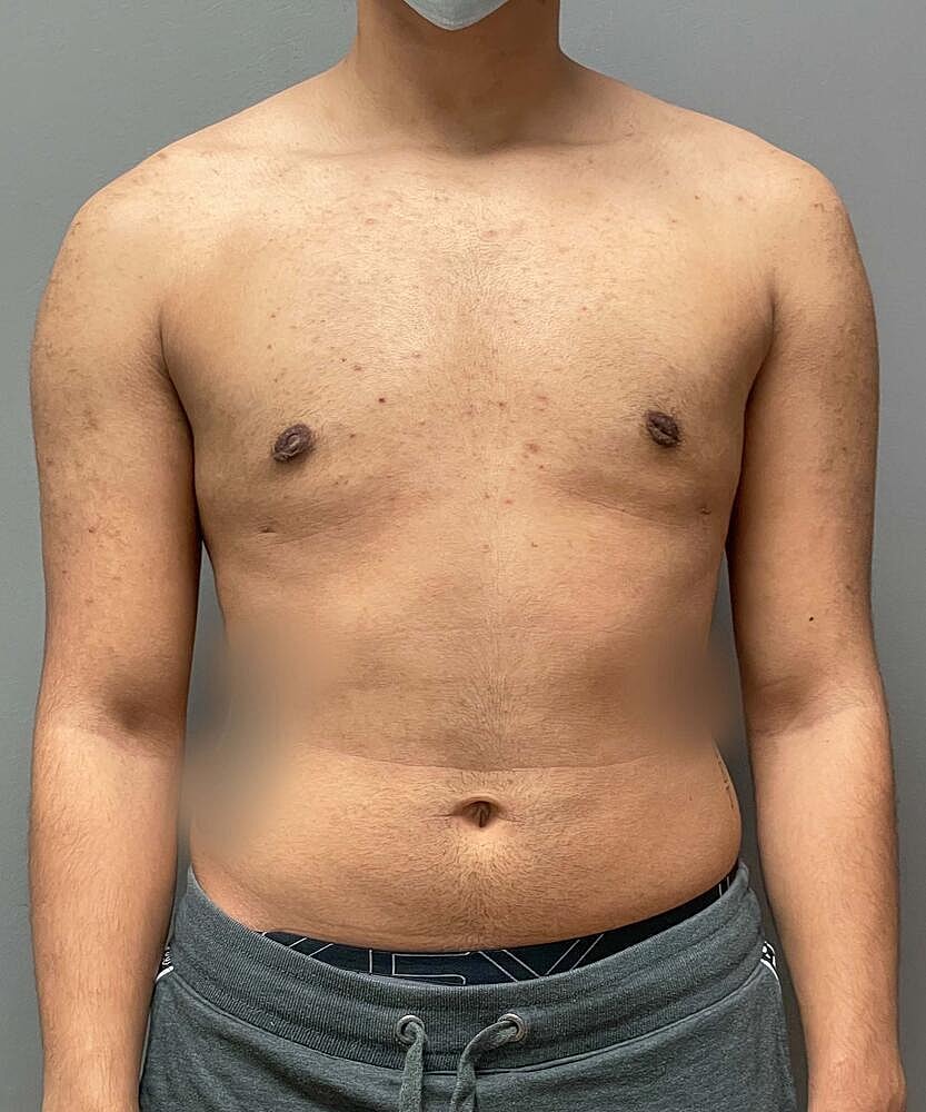 Gynecomastectomy Before & After