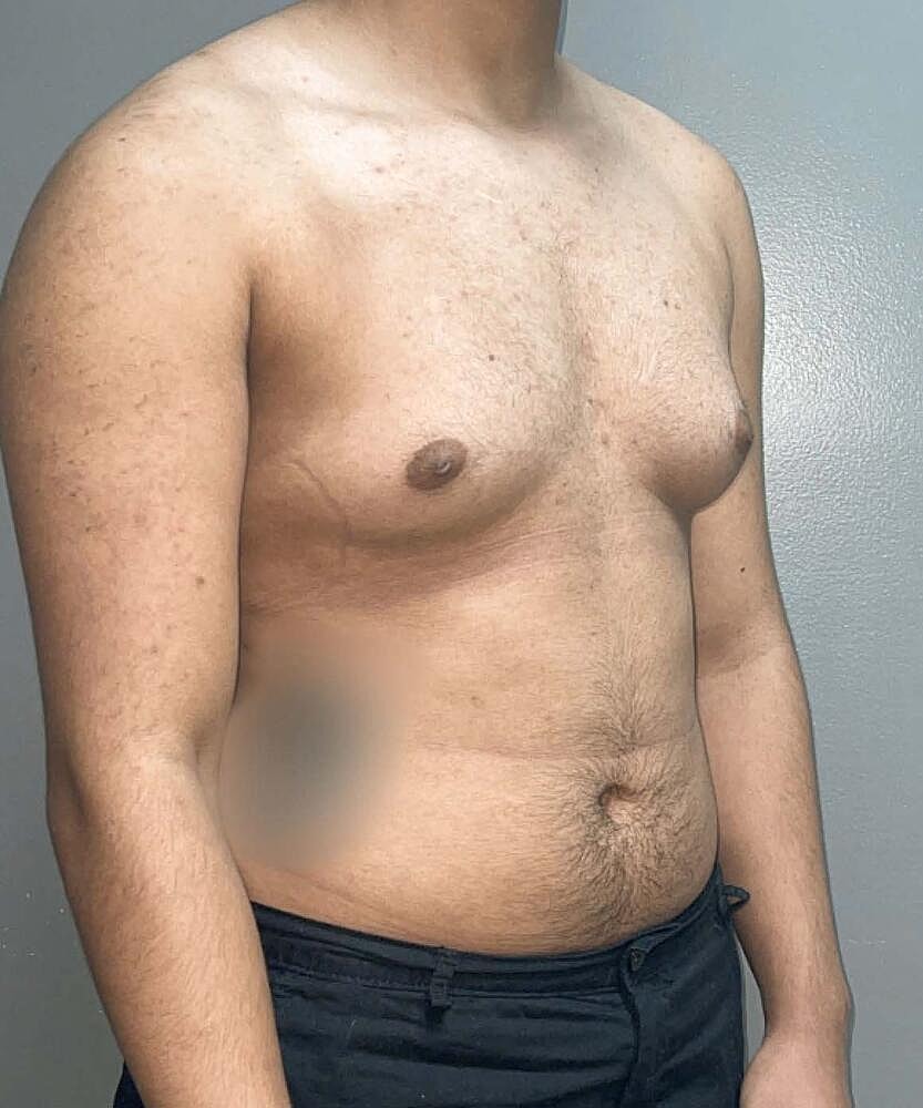 Gynecomastectomy Before & After