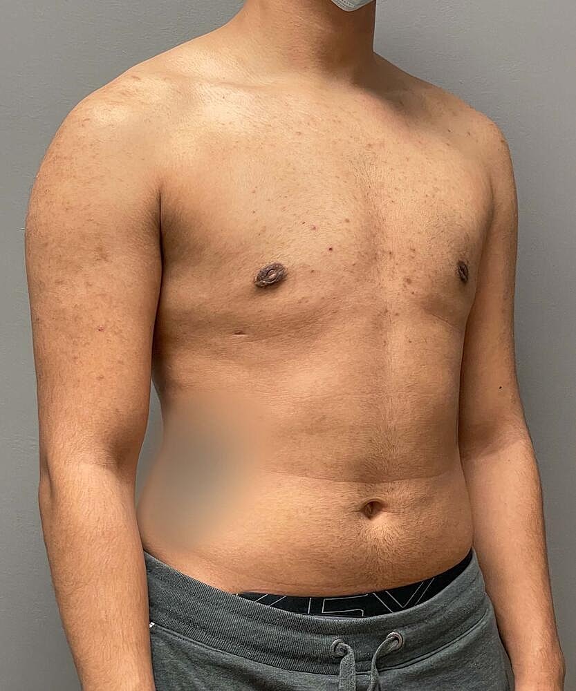 Gynecomastectomy Before & After