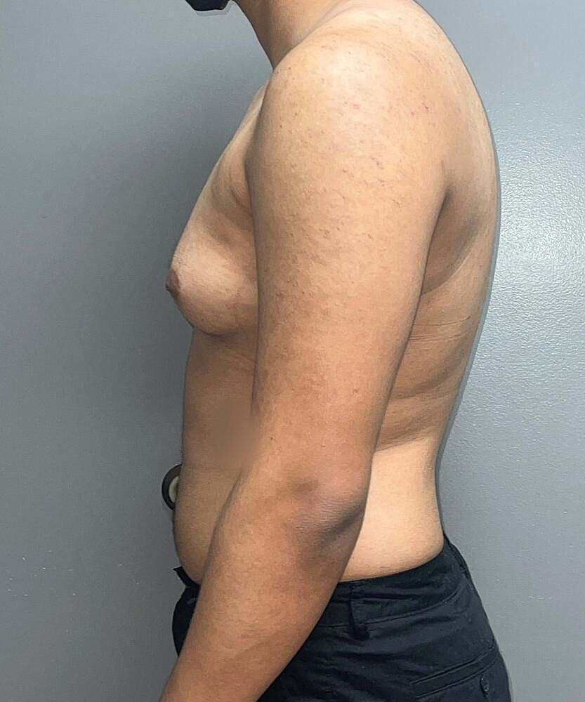 Gynecomastectomy Before & After