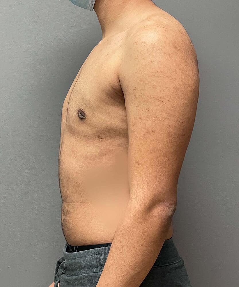Gynecomastectomy Before & After
