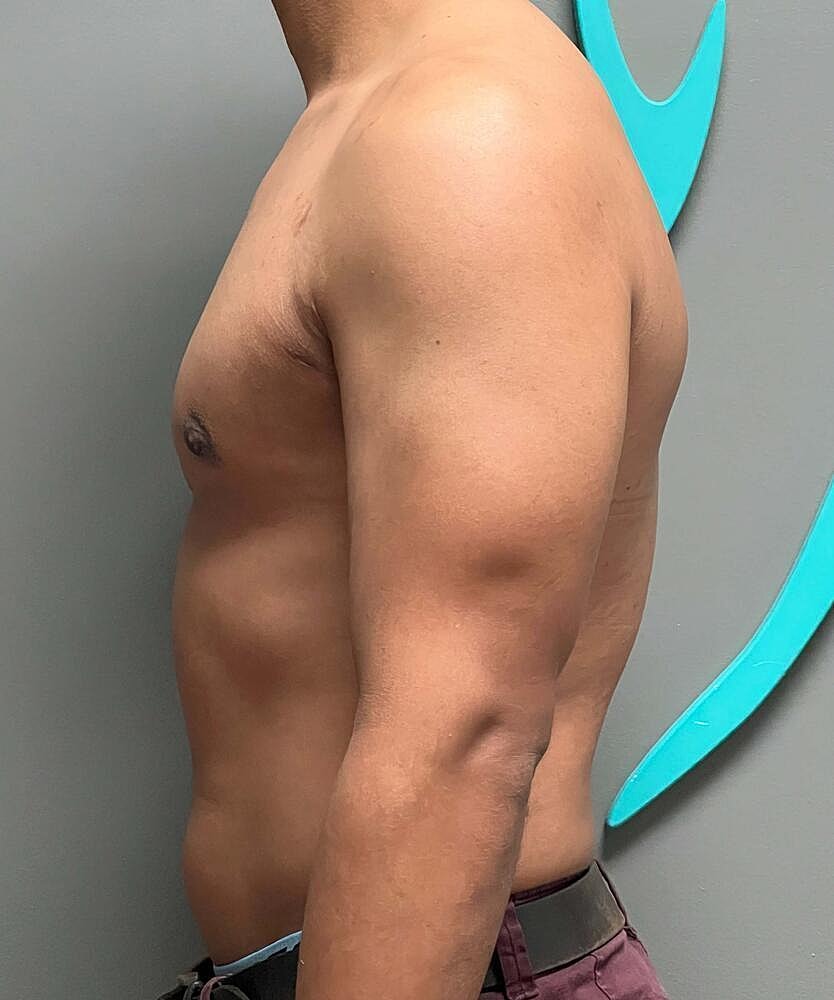 Gynecomastectomy Before & After