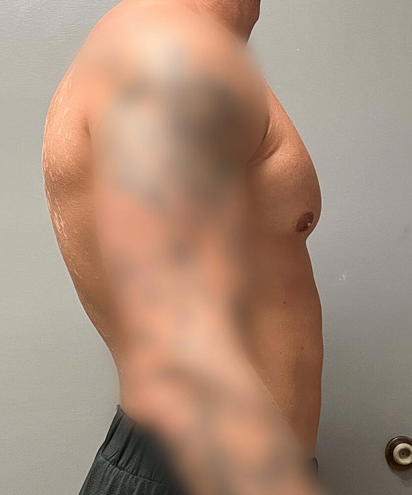 Gynecomastectomy Before & After