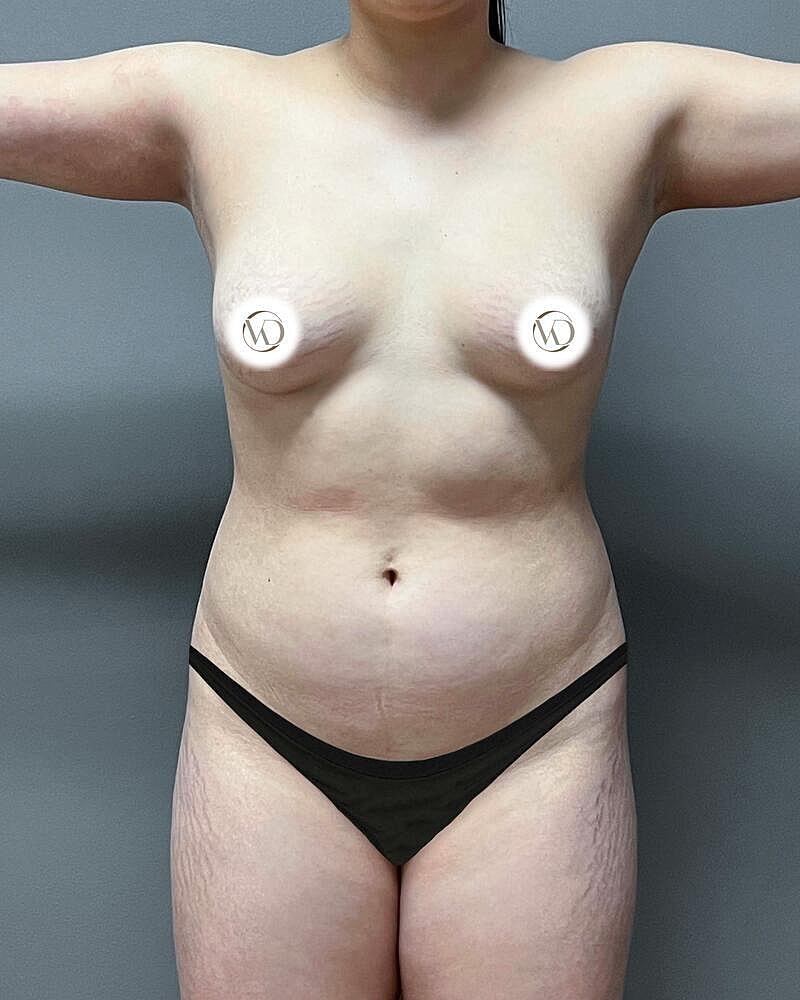 Fat Grafting To Hips Before & After