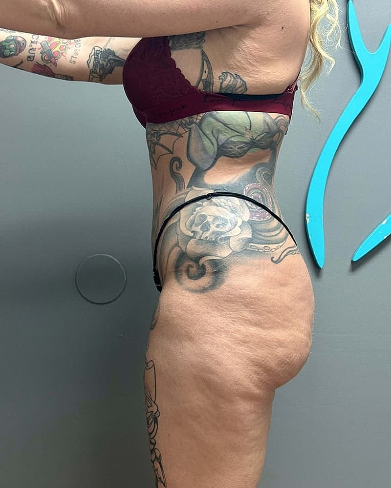 Fat Grafting To Hips Before & After