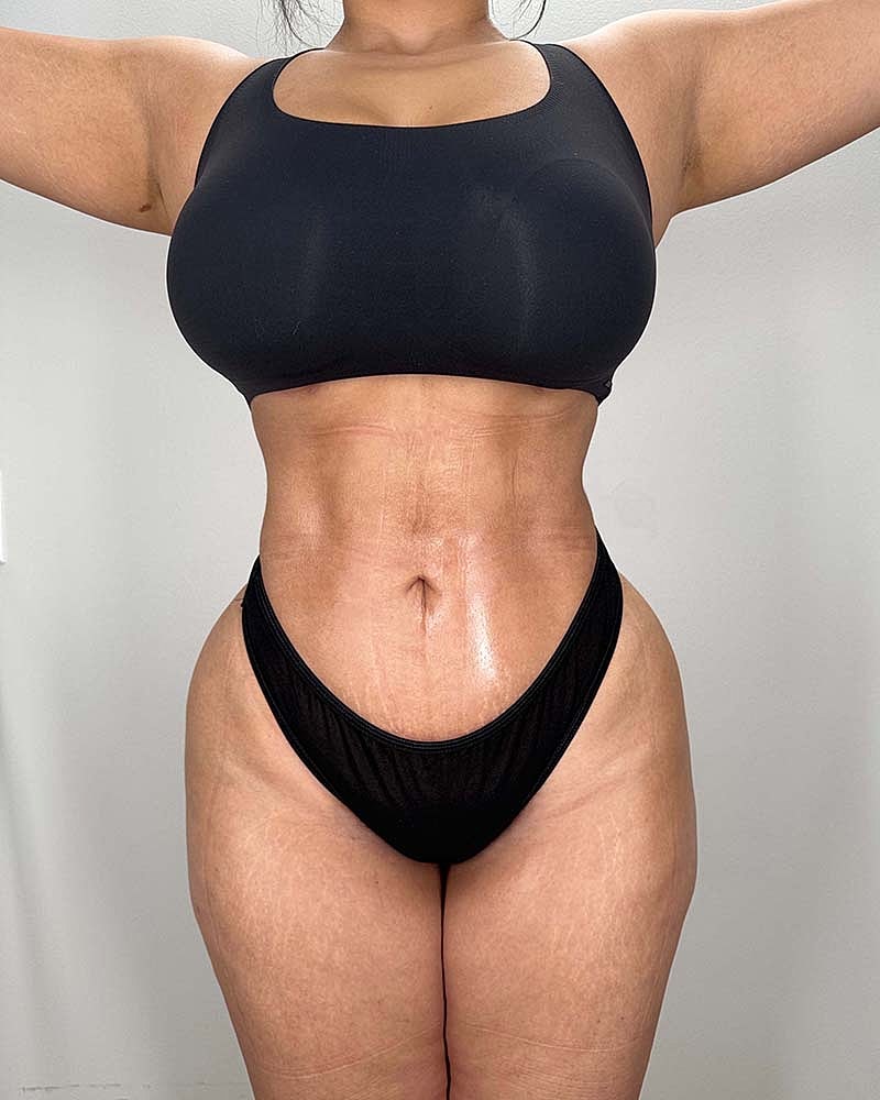 Fat Grafting To Hips Before & After