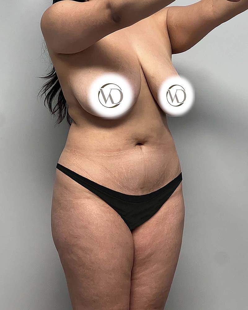 Fat Grafting To Hips Before & After