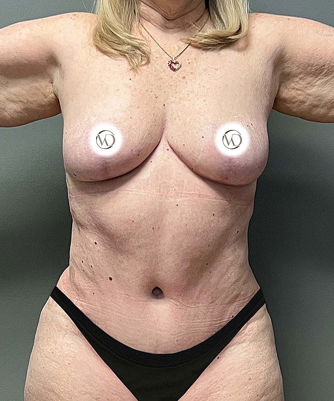 Breast Lift Before & After