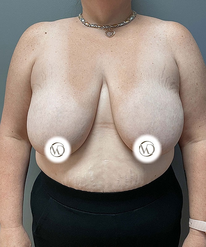 Breast Lift Before & After