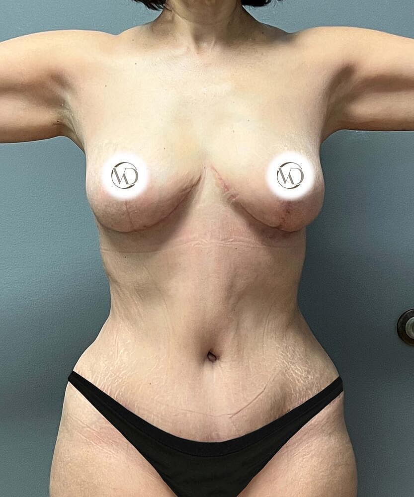 Breast Lift Before & After
