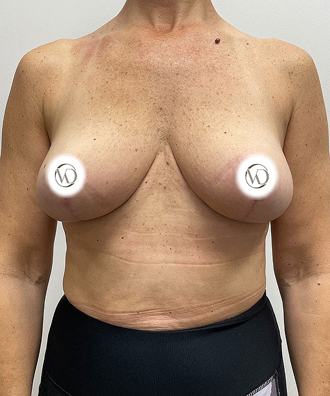 Breast Lift Before & After