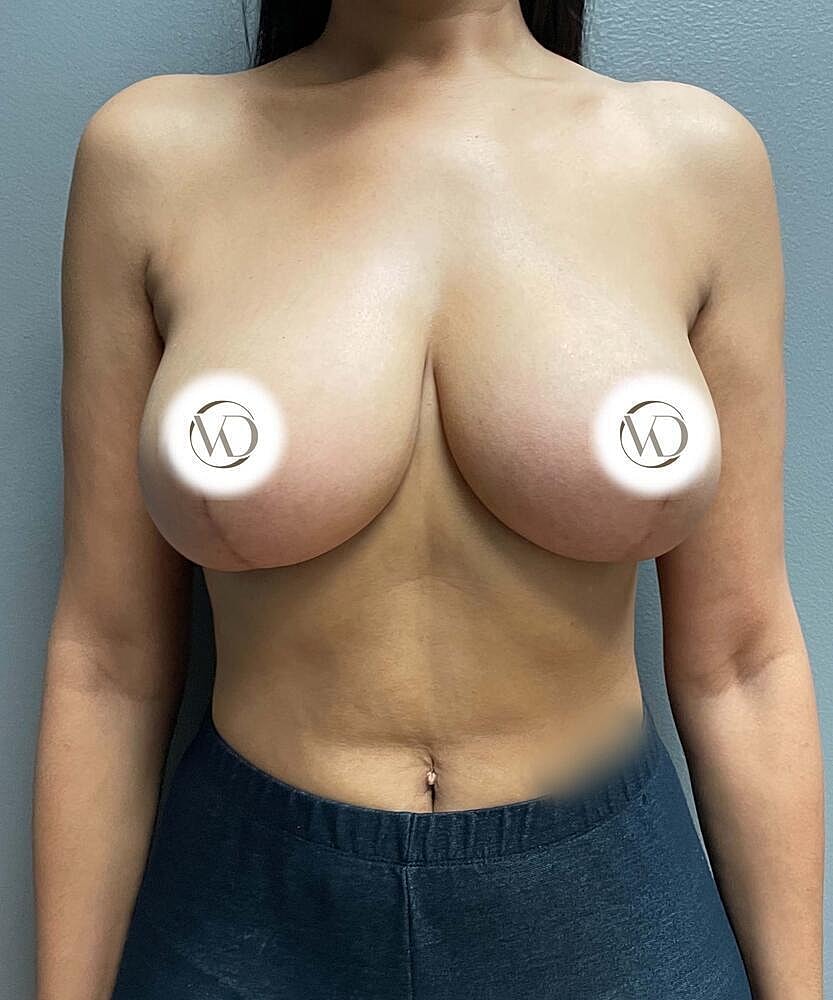 Breast Lift Before & After