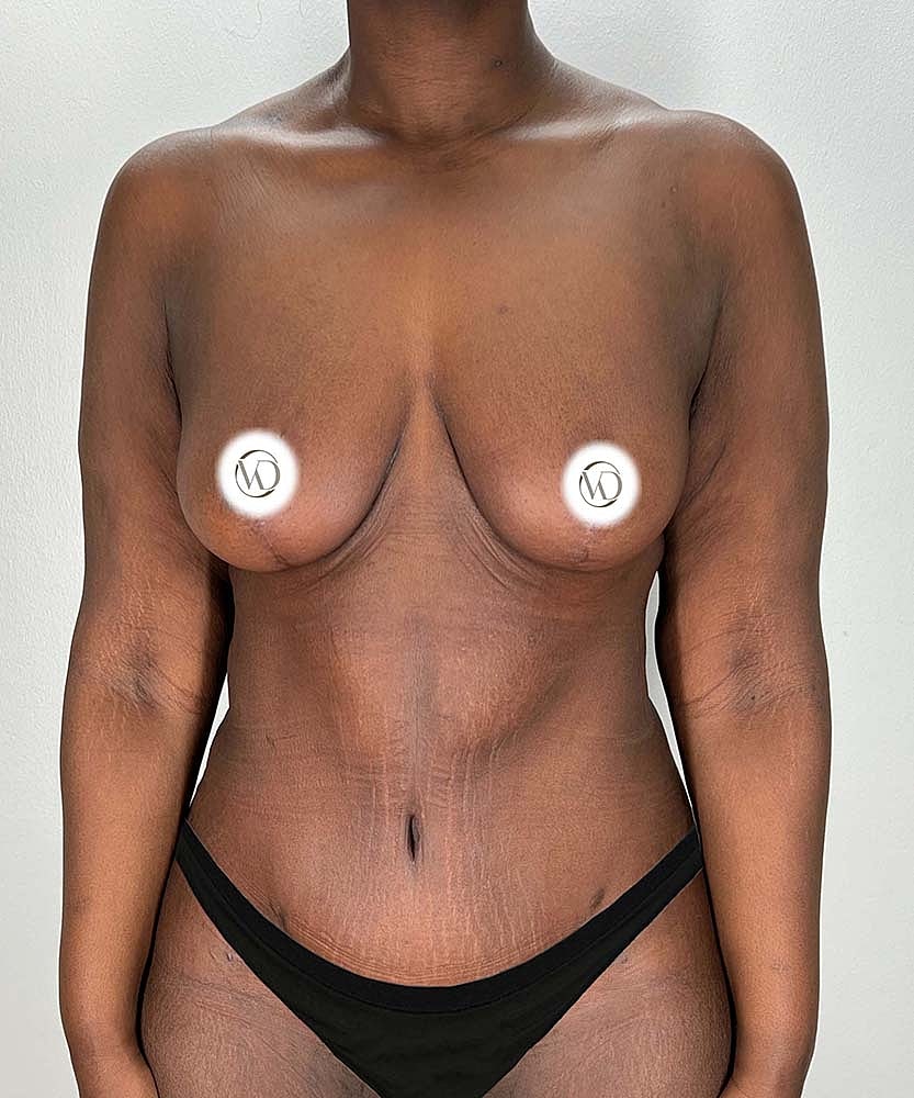 Breast Lift Before & After