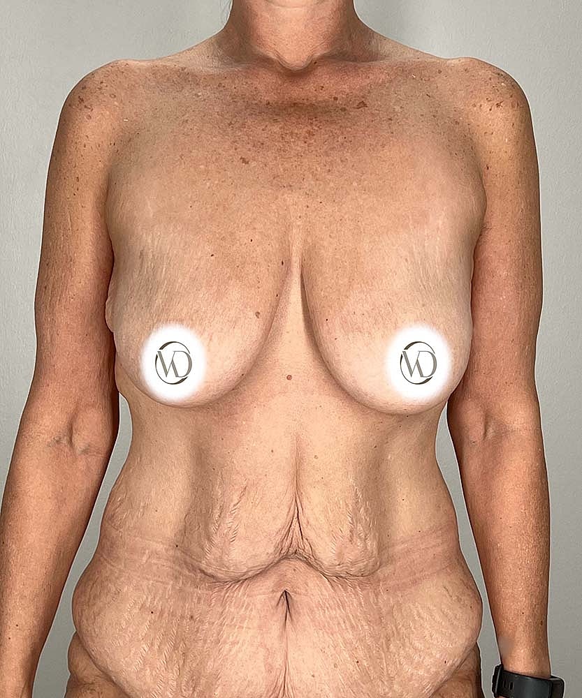 Breast Lift Before & After