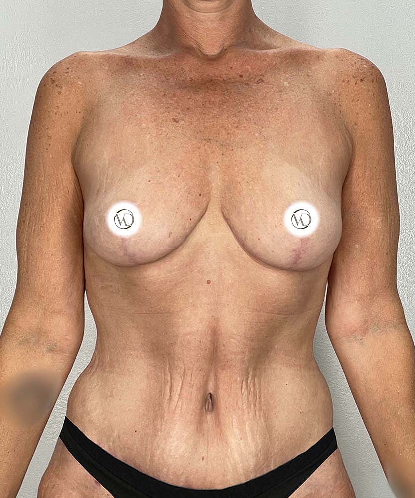 Breast Lift Before & After