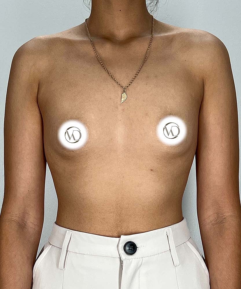 Breast Augmentation Before & After