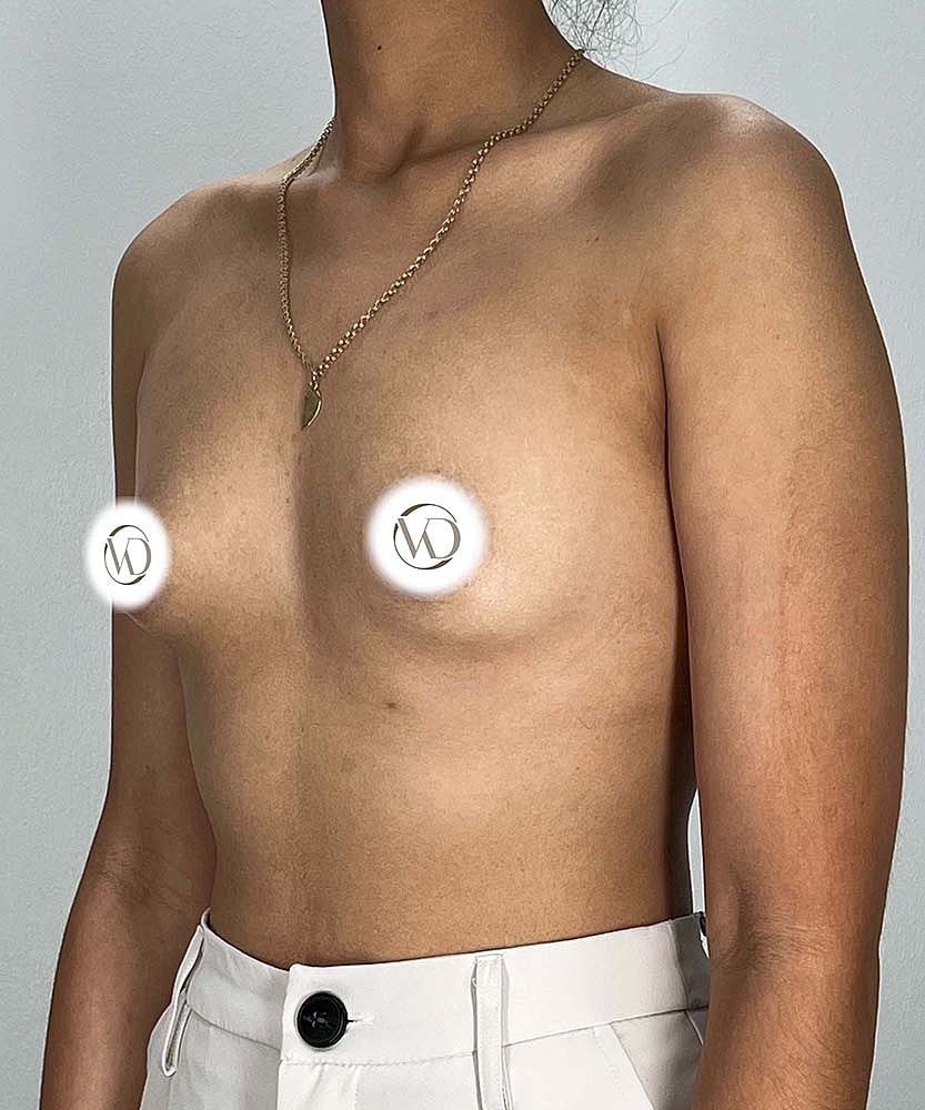Breast Augmentation Before & After