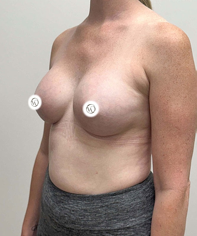 Breast Augmentation Before & After