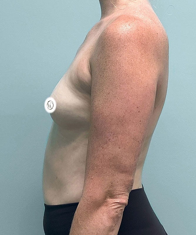 Breast Augmentation Before & After