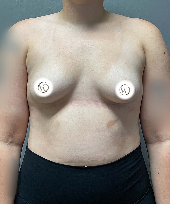 Breast Augmentation Before & After