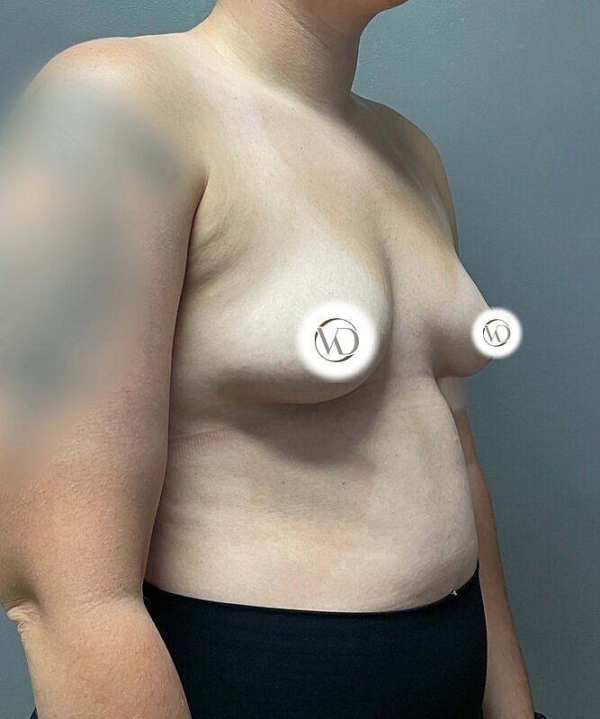 Breast Augmentation Before & After