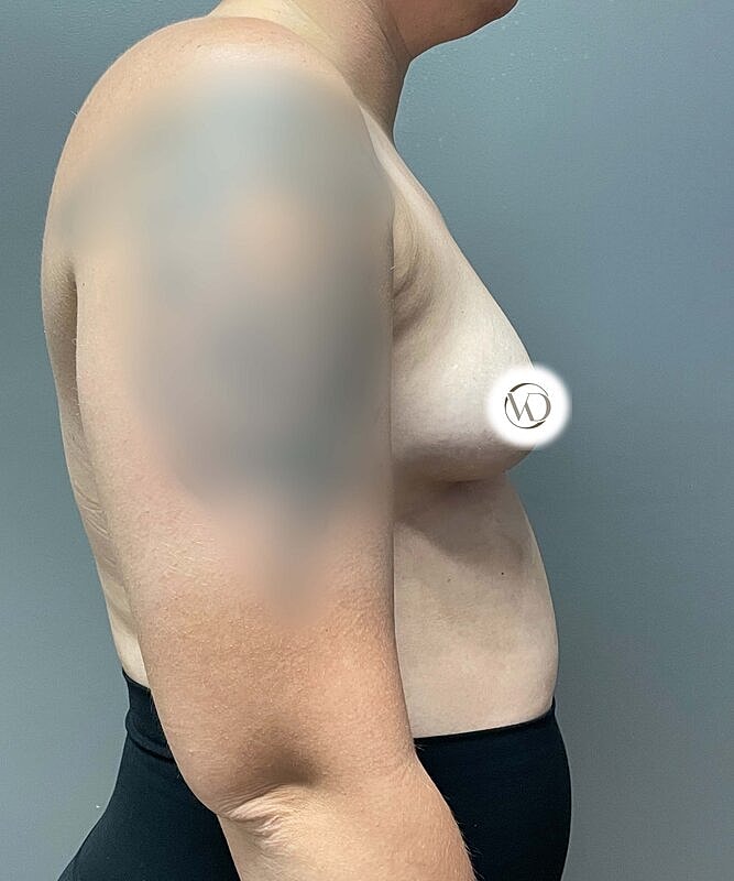 Breast Augmentation Before & After