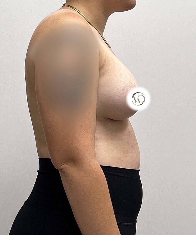 Breast Augmentation Before & After