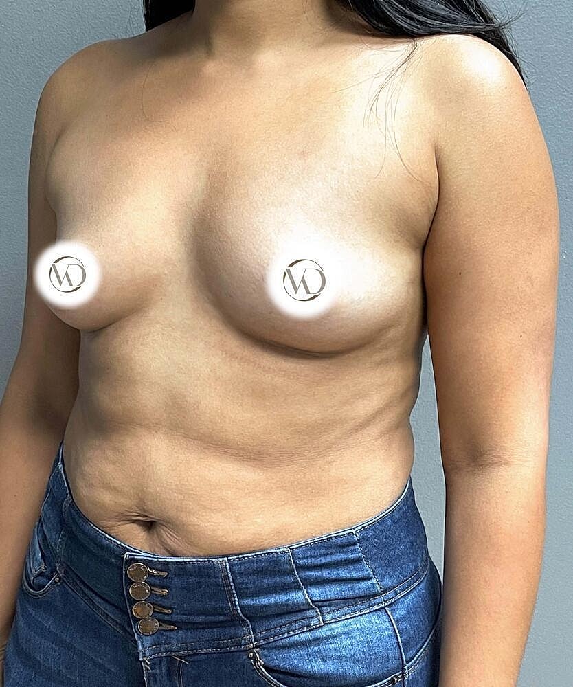Breast Augmentation Before & After