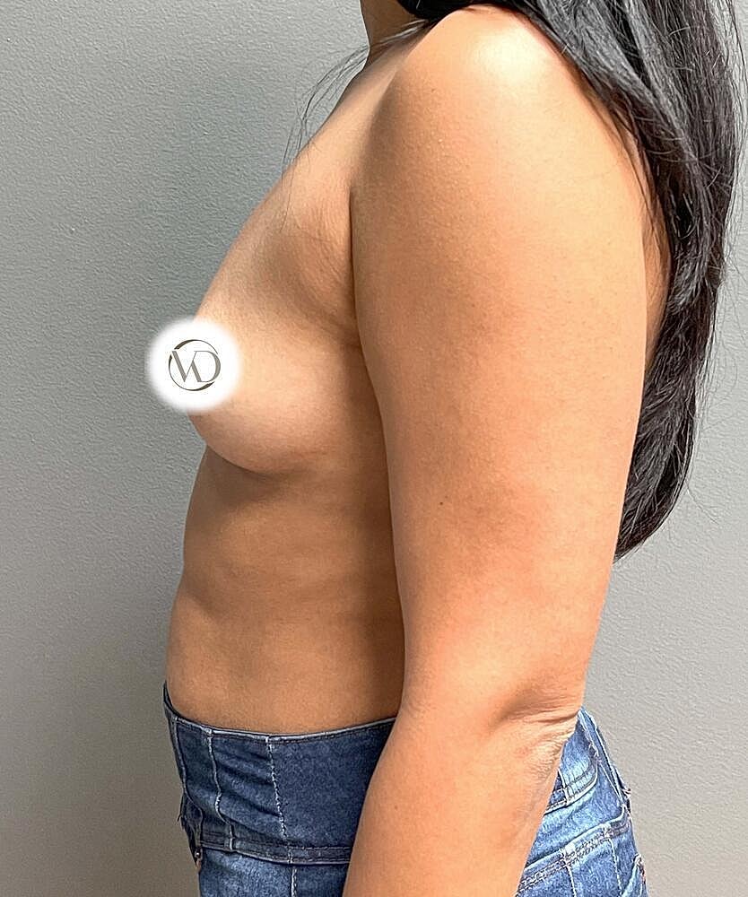 Breast Augmentation Before & After