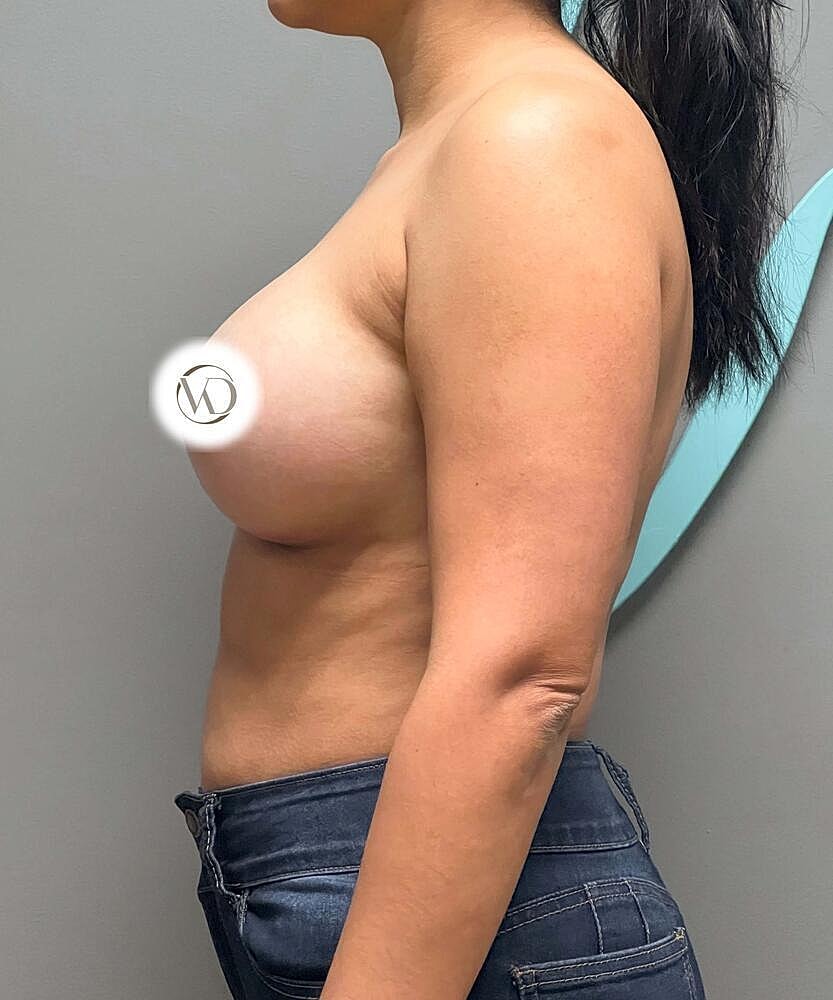 Breast Augmentation Before & After