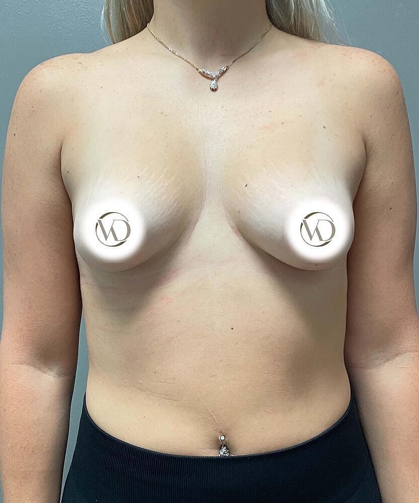 Breast Augmentation Before & After