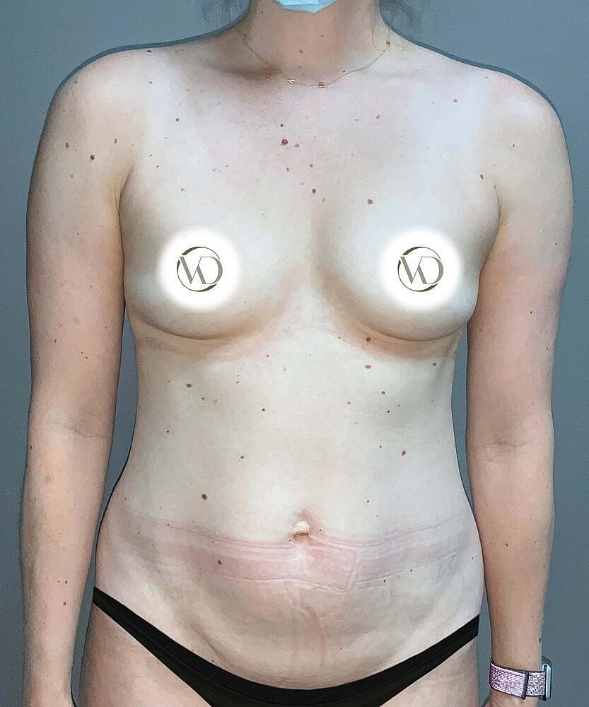 Breast Augmentation Before & After