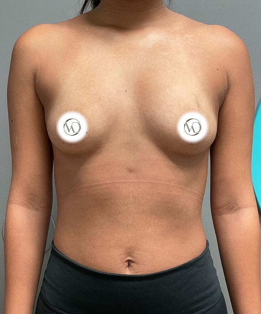 Breast Augmentation Before & After
