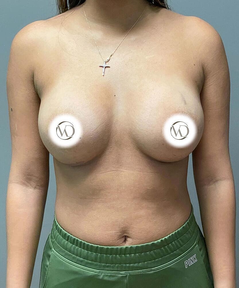Breast Augmentation Before & After